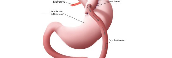 Bypass Gastrico Blog Vida Sanablog Vida Sana